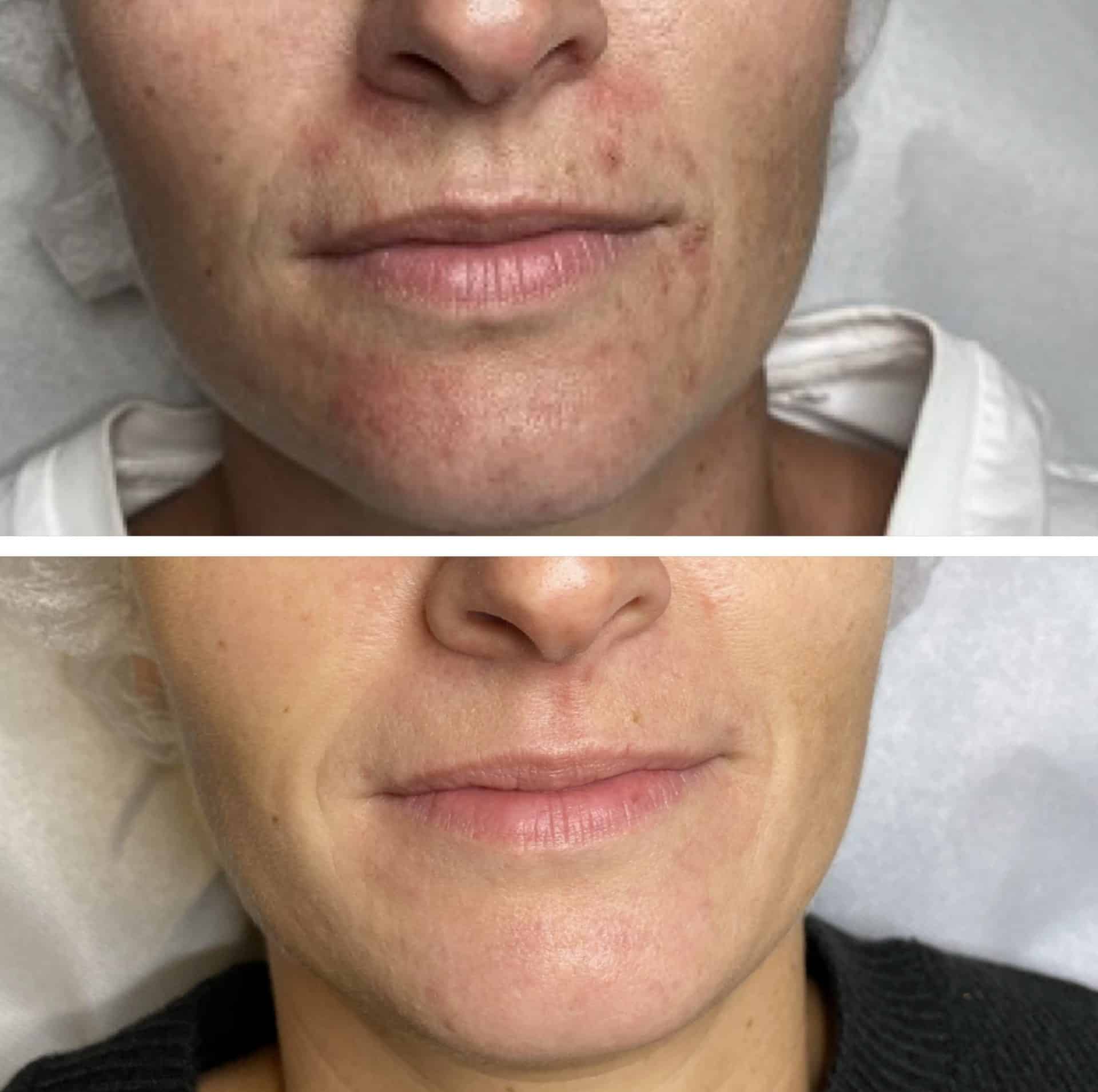 Behandling af Perioral dermatitis