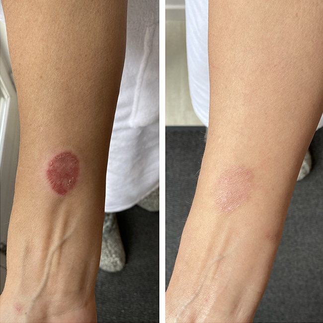 Cryosauna behandling mod hudproblemer i Vejle