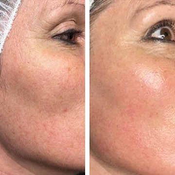 Green peel - urtebehandling anti-age
