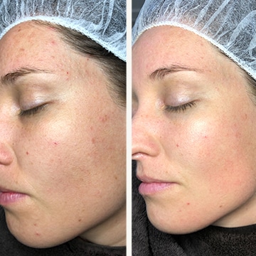 Green peel - urtebehandling anti-age