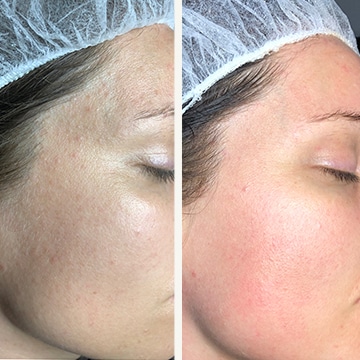 Green peel - urtebehandling anti-age