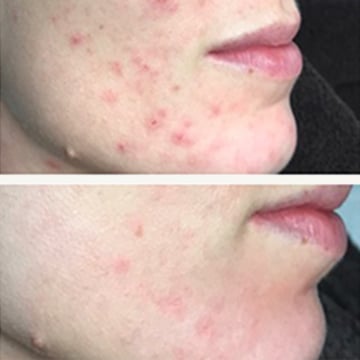 Green peel - urtebehandling anti-age