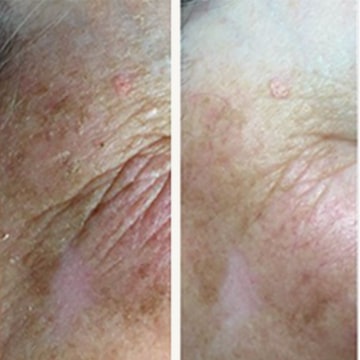 Green peel - urtebehandling anti-age