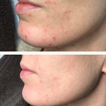 Green peel - urtebehandling anti-age