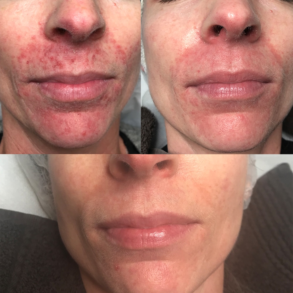 Perioral dermatitis behandlingsforløb