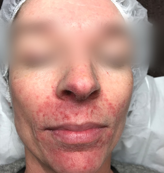 Perioral dermatitis