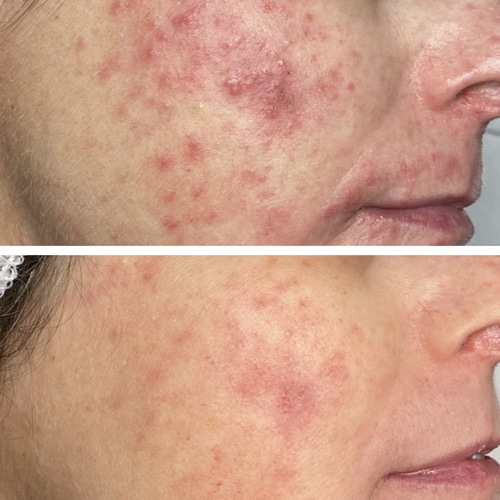 Rosacea før og efter
