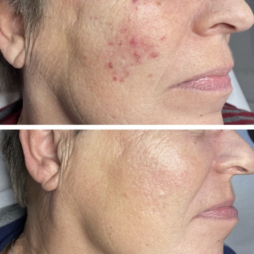 Rosacea før og efter