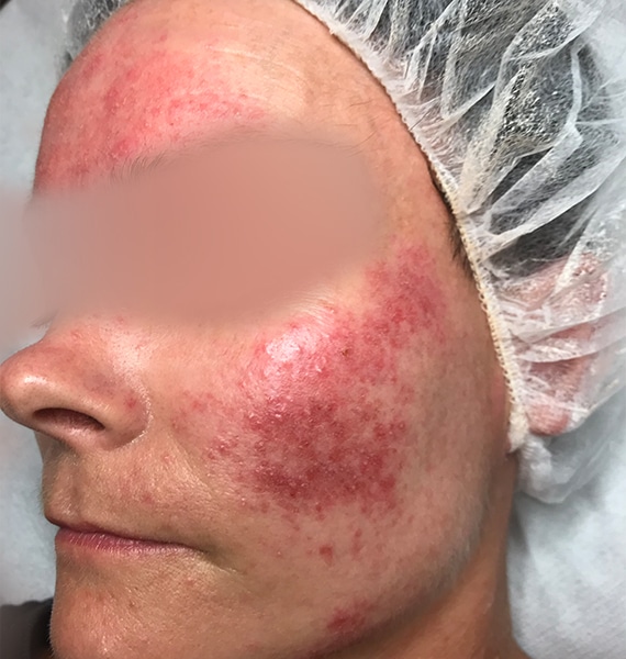 Rosacea