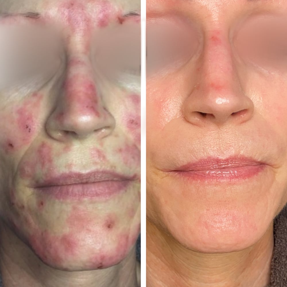 Rosacea
