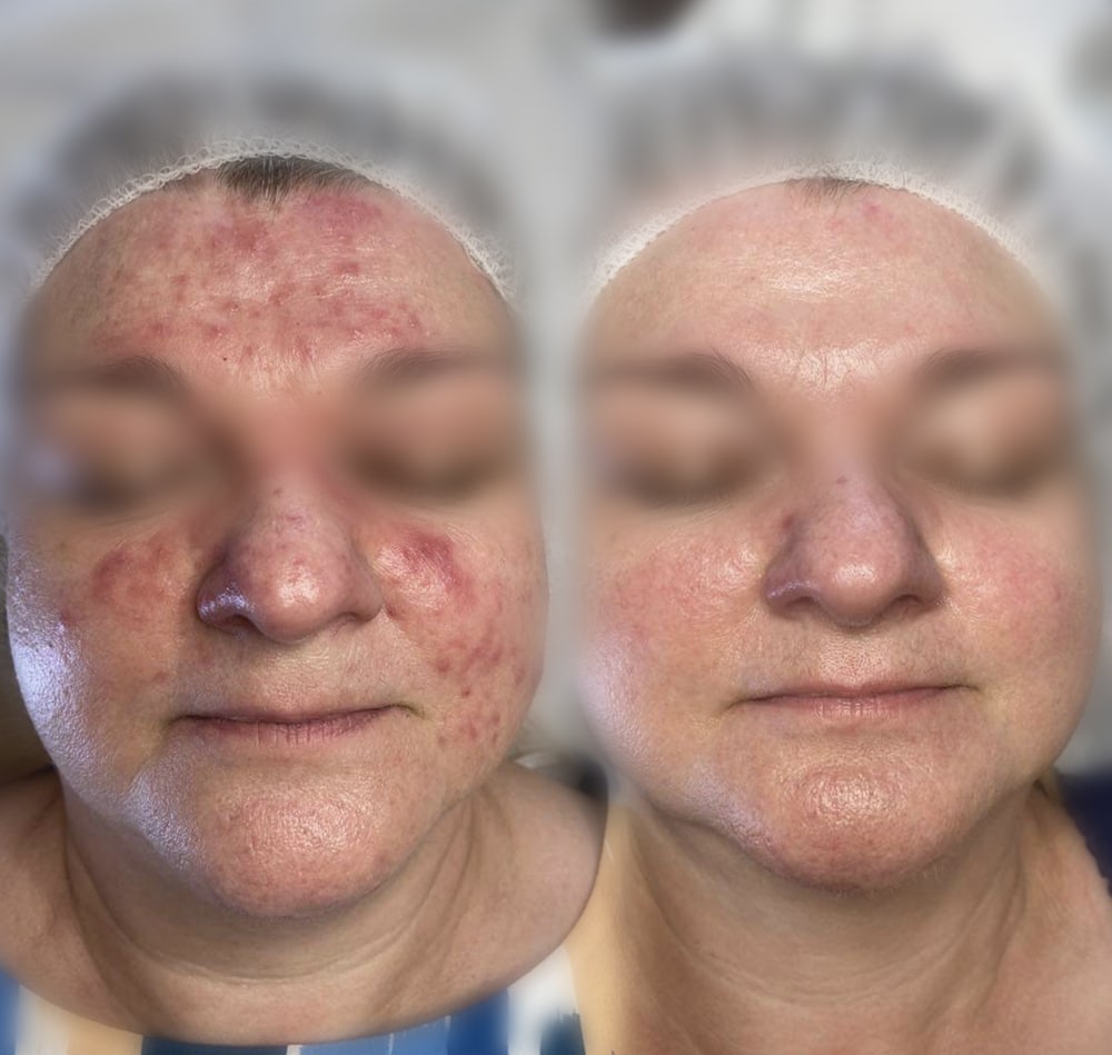 Rosacea behandling og kurforløb