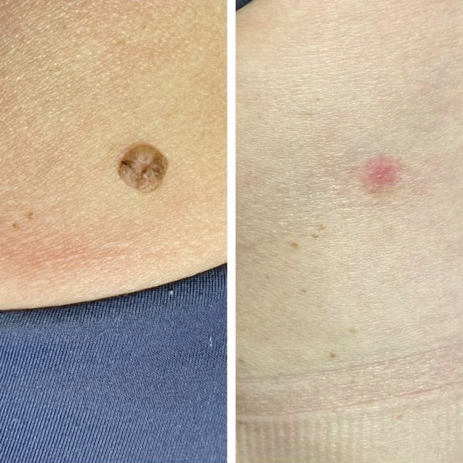 Fjernelse af gevækster med laser