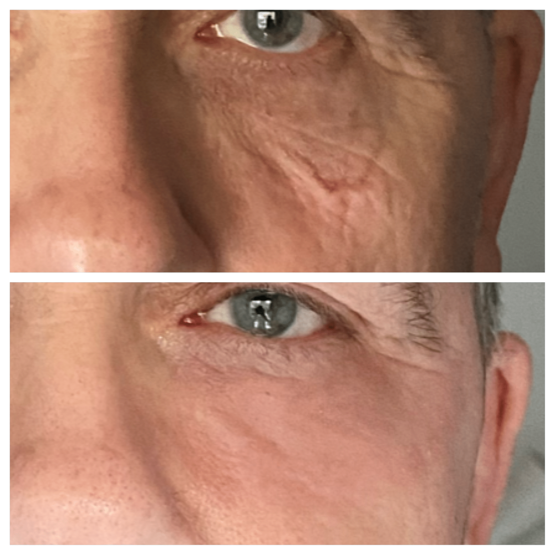 co2 laser behandling - Anti-age