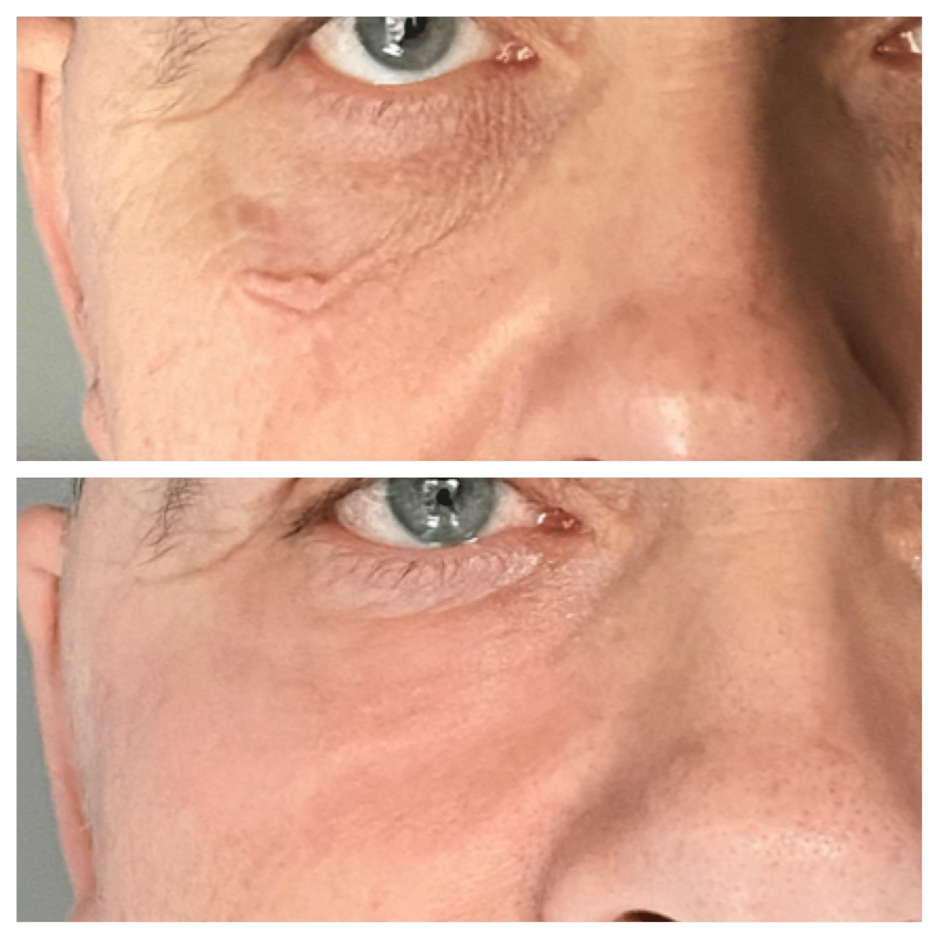 co2 laser behandling - Anti-age