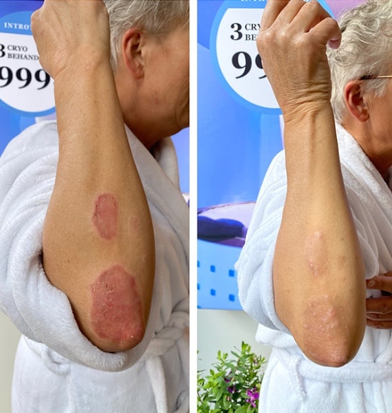 Psoriasis og cryosauna behandling