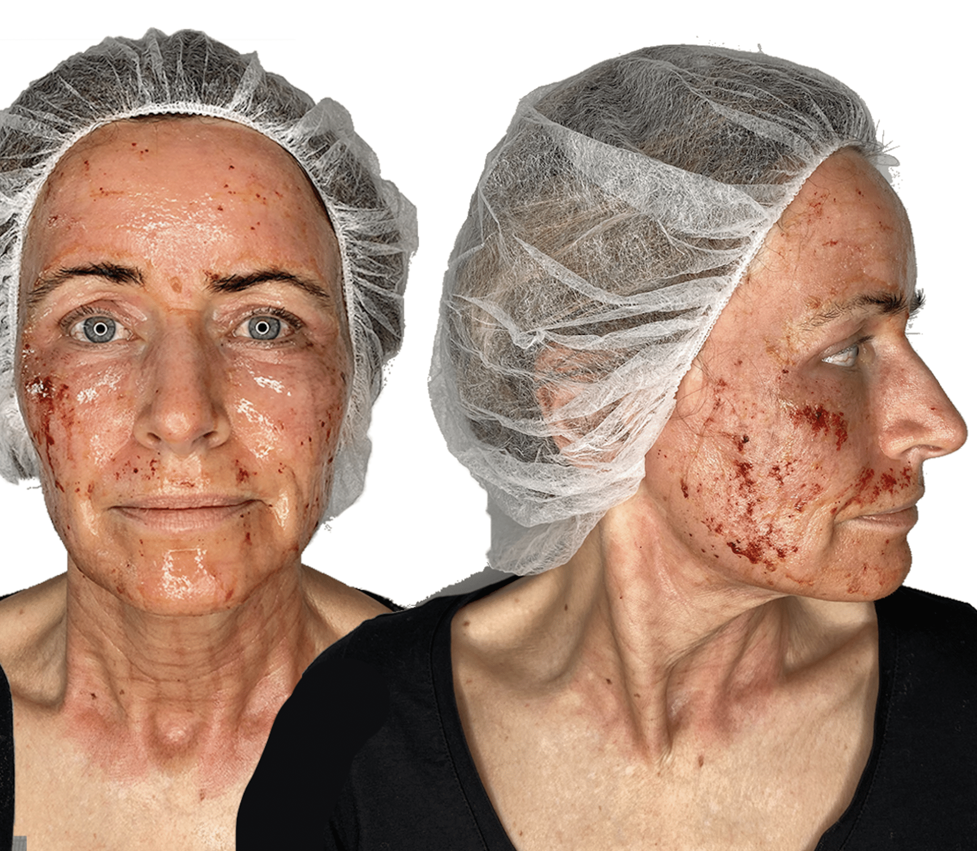 behandling med c02 laser - anti-age behandling