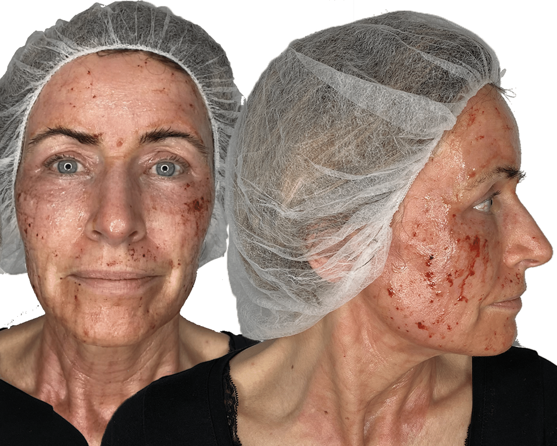 behandling med c02 laser - anti-age behandling