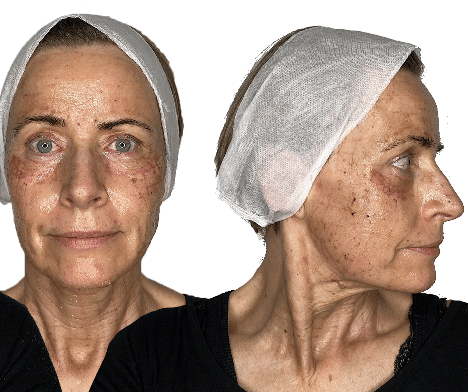 behandling med c02 laser - anti-age behandling