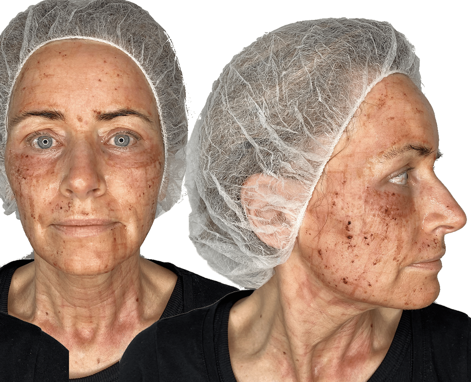 behandling med c02 laser - anti-age behandling