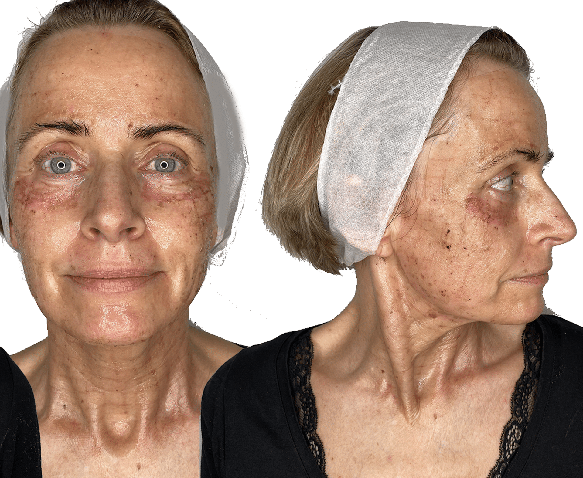 behandling med c02 laser - anti-age behandling