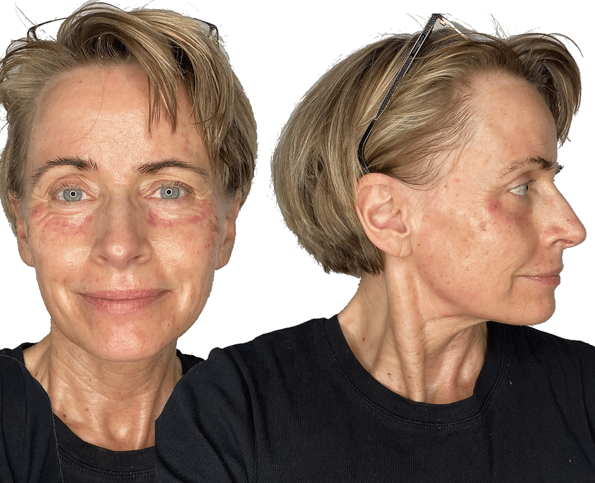 behandling med c02 laser - anti-age behandling
