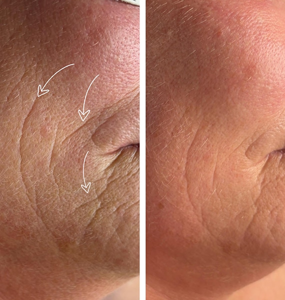EMS Facelift før & efter