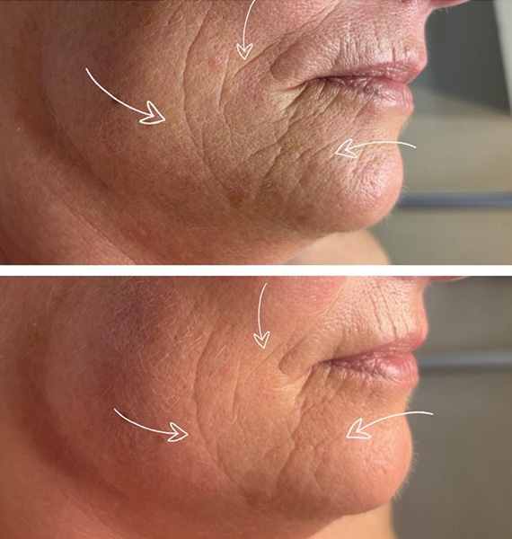 EMS Facelift før & efter