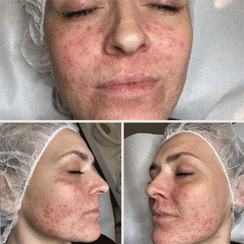Kurforløb Perioral dermatitis