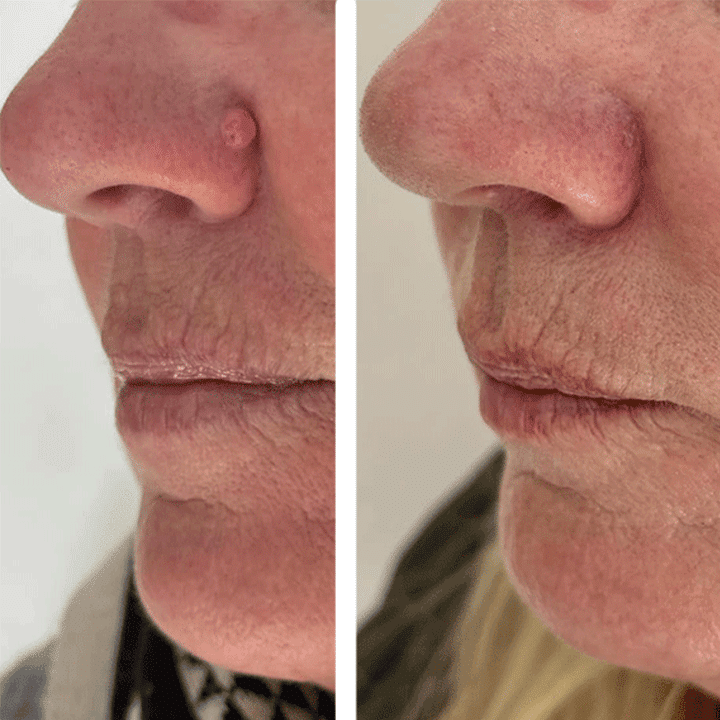 Fjernelse af gevækst - før & efter - Hos Klinik MARIANNE BISGAARD i Vejle