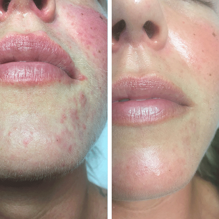 Perioral dermatitis 1