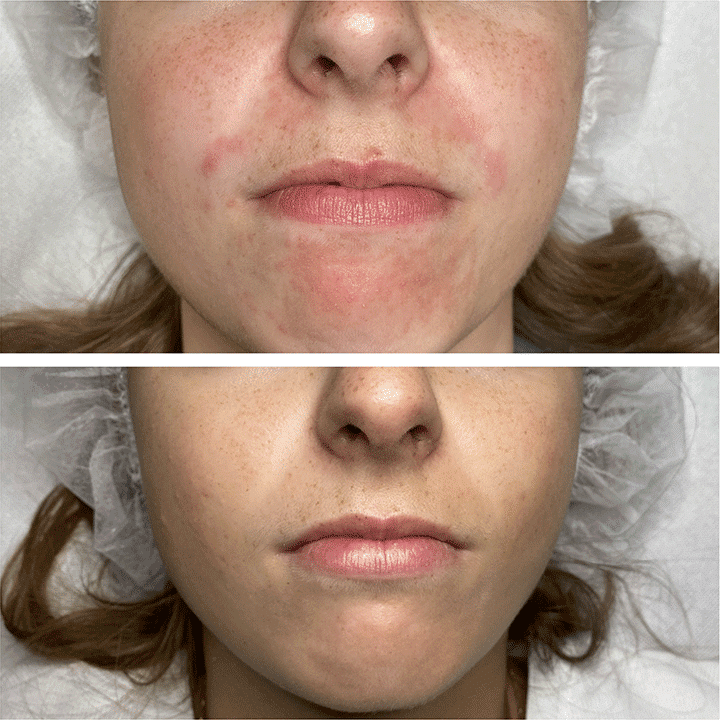 Behandling af Perioral dermatitis i Vejle hos Klinik Marianne Bisgaard