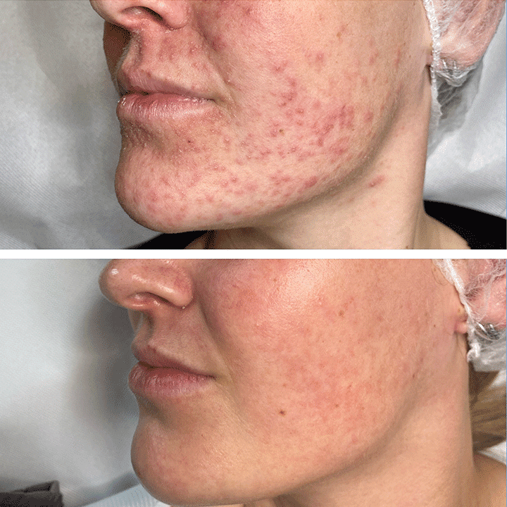 Behandling af Perioral dermatitis i Vejle hos Klinik Marianne Bisgaard