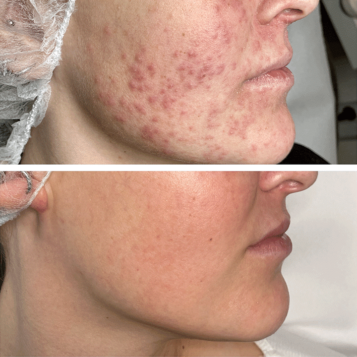 Behandling af Perioral dermatitis i Vejle hos Klinik Marianne Bisgaard