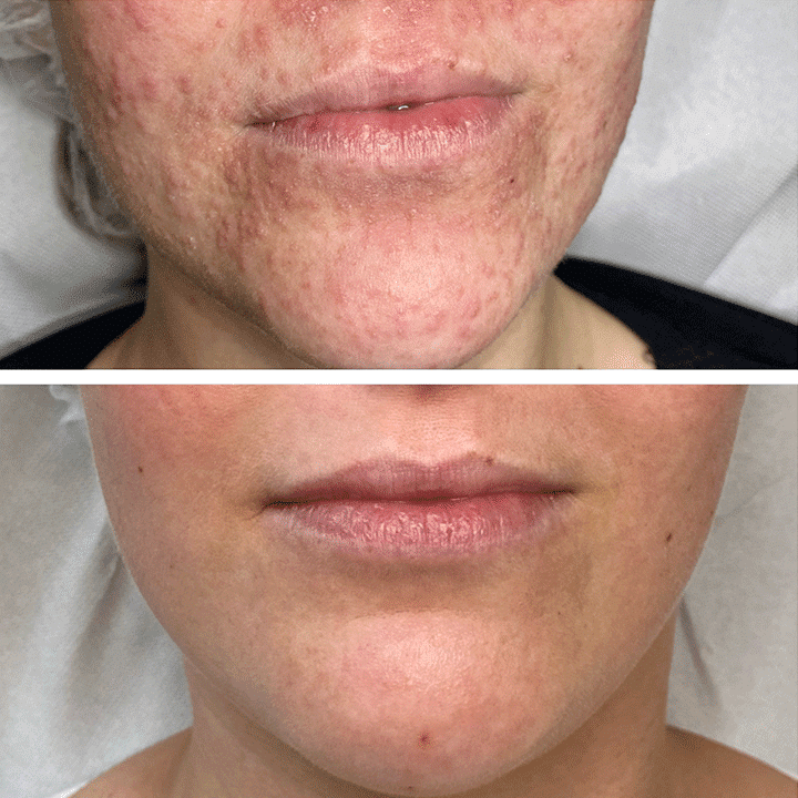 Behandling af Perioral dermatitis i Vejle hos Klinik Marianne Bisgaard