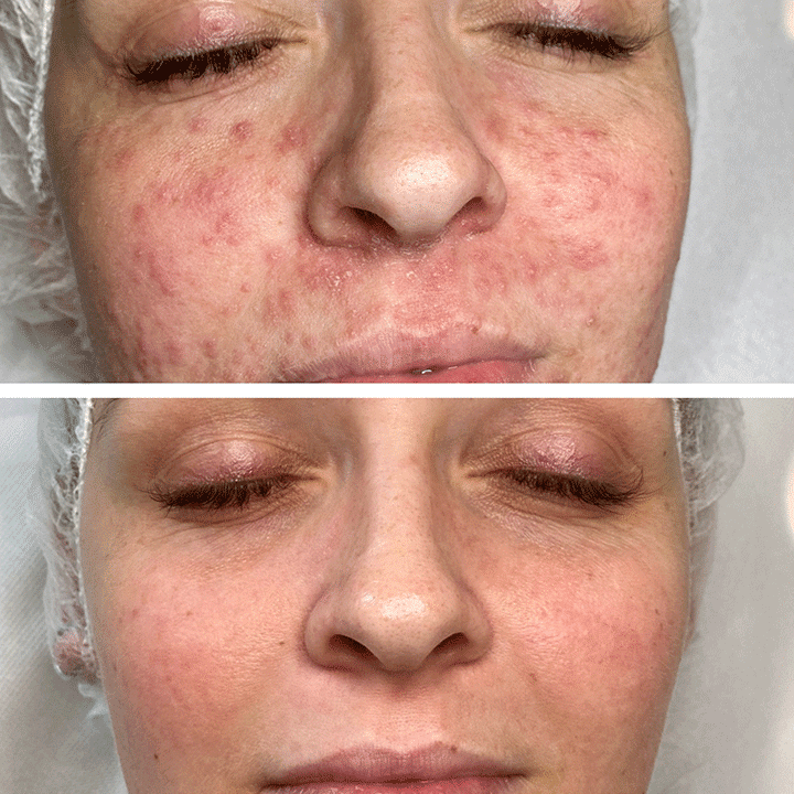 Behandling af Perioral dermatitis i Vejle hos Klinik Marianne Bisgaard