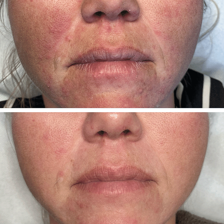 Behandling af Perioral dermatitis i Vejle hos Klinik Marianne Bisgaard