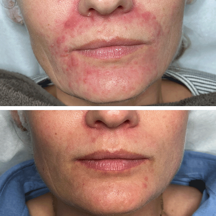 Behandling af Perioral dermatitis i Vejle hos Klinik Marianne Bisgaard