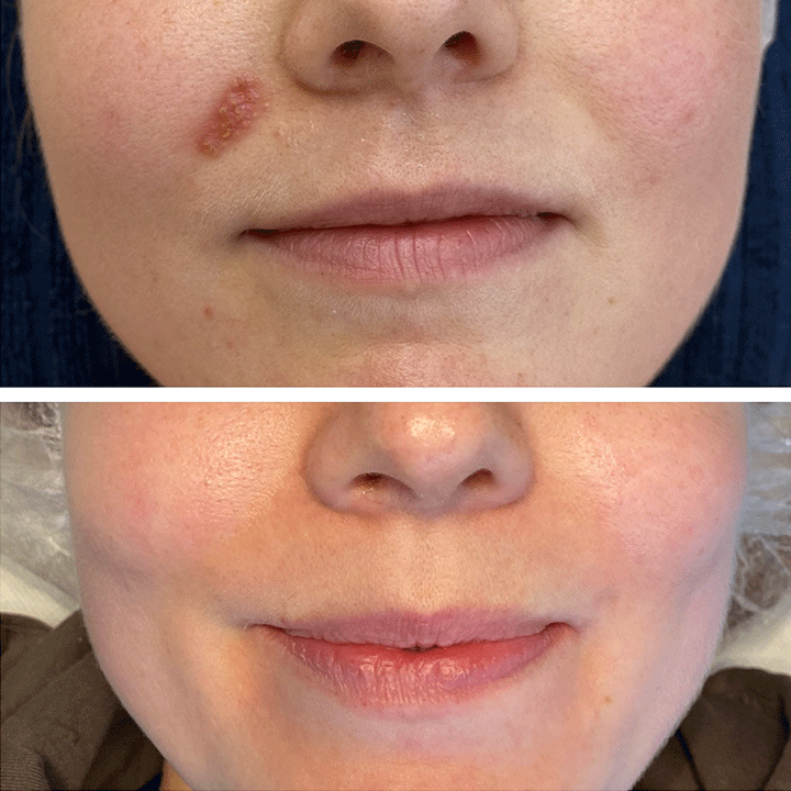 Behandling af Perioral dermatitis i Vejle hos Klinik Marianne Bisgaard