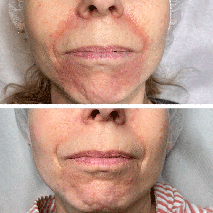 Behandling af Perioral dermatitis i Vejle hos Klinik Marianne Bisgaard