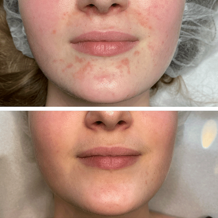 Behandling af Perioral dermatitis i Vejle hos Klinik Marianne Bisgaard