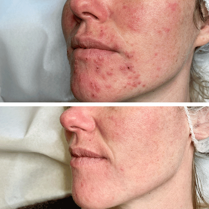 Behandling af Perioral dermatitis i Vejle hos Klinik Marianne Bisgaard