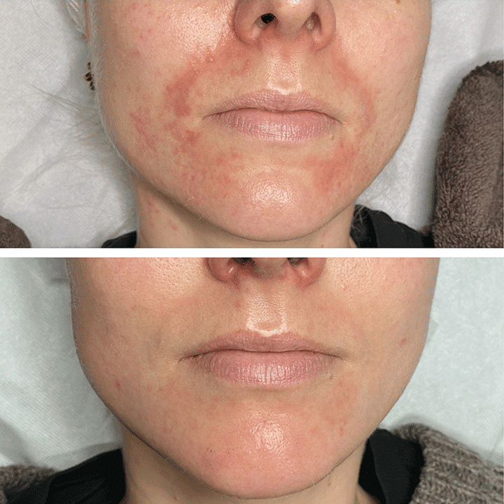 Behandling af Perioral dermatitis i Vejle hos Klinik Marianne Bisgaard