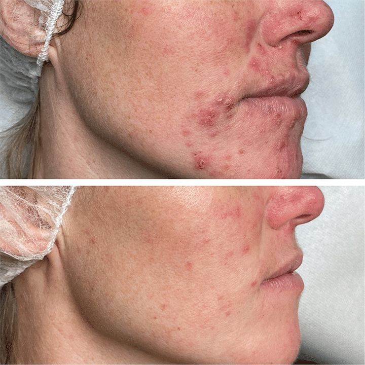 Behandling af Perioral dermatitis i Vejle hos Klinik Marianne Bisgaard