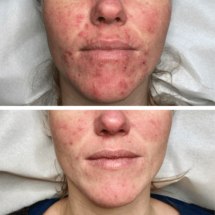 Behandling af Perioral dermatitis i Vejle hos Klinik Marianne Bisgaard