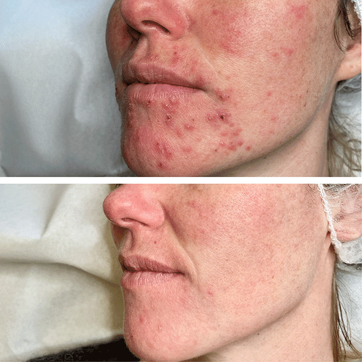Behandling af hudsygdom og hudproblemer -Rosacea - Hos klinik Marianne Bisgaard i Vejle