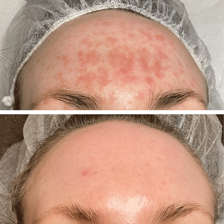 Behandling af hudsygdom og hudproblemer -Rosacea - Hos klinik Marianne Bisgaard i Vejle
