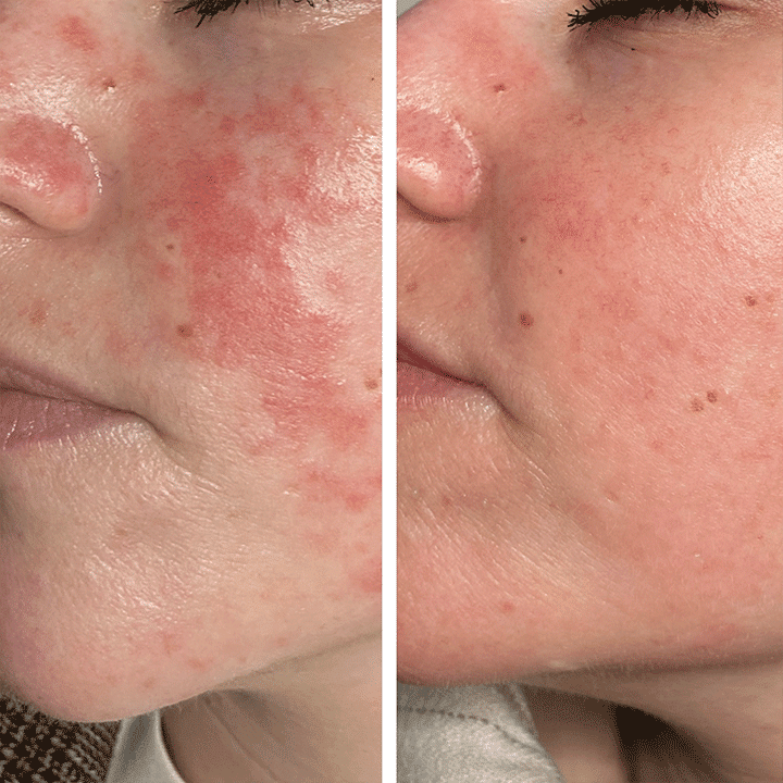 Behandling af hudsygdom og hudproblemer -Rosacea - Hos klinik Marianne Bisgaard i Vejle