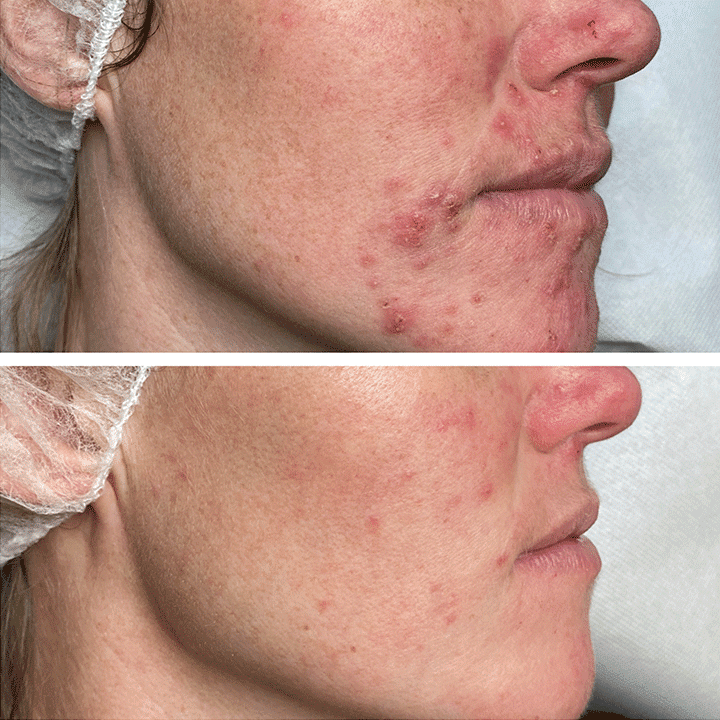 Behandling af hudsygdom og hudproblemer -Rosacea - Hos klinik Marianne Bisgaard i Vejle