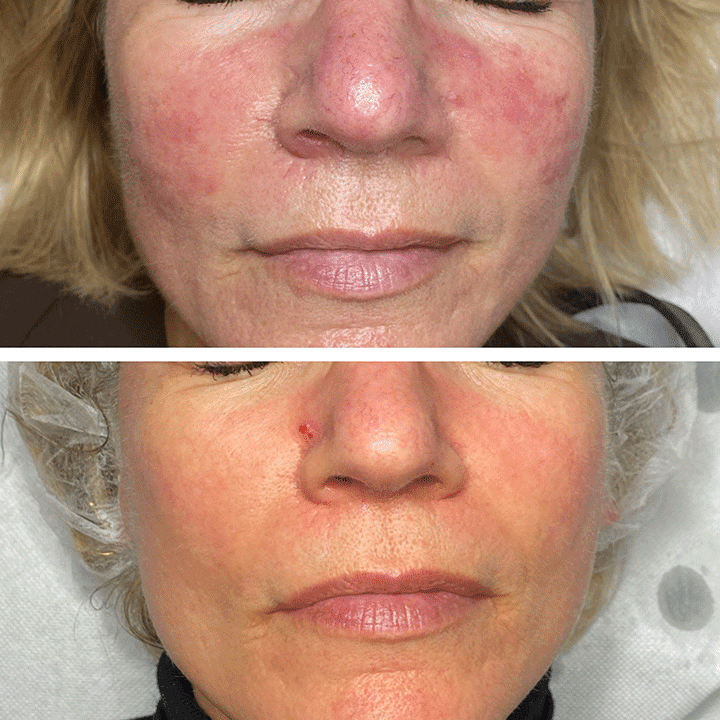Behandling af hudsygdom og hudproblemer -Rosacea - Hos klinik Marianne Bisgaard i Vejle
