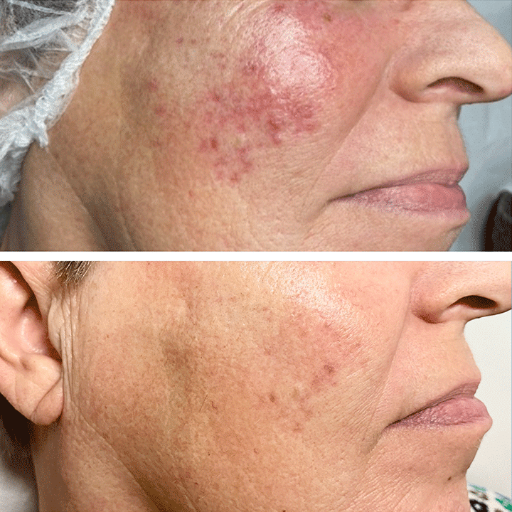 Behandling af hudsygdom og hudproblemer -Rosacea - Hos klinik Marianne Bisgaard i Vejle